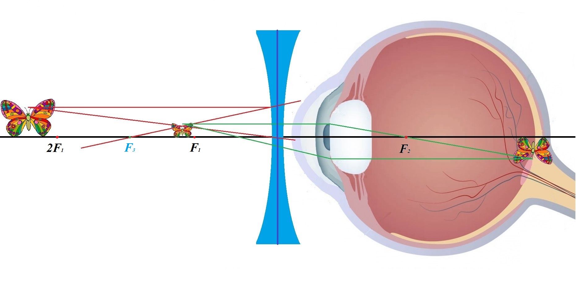 Коррекция зрения с помощью линз. Миопия двояковогнутые линзы. Двояковогнутая линза для близорукости. Двояковогнутые линзы при близорукости. Линзы для глаз для зрения дальнозоркость.